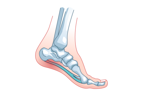 Ilustración: fascitis plantar