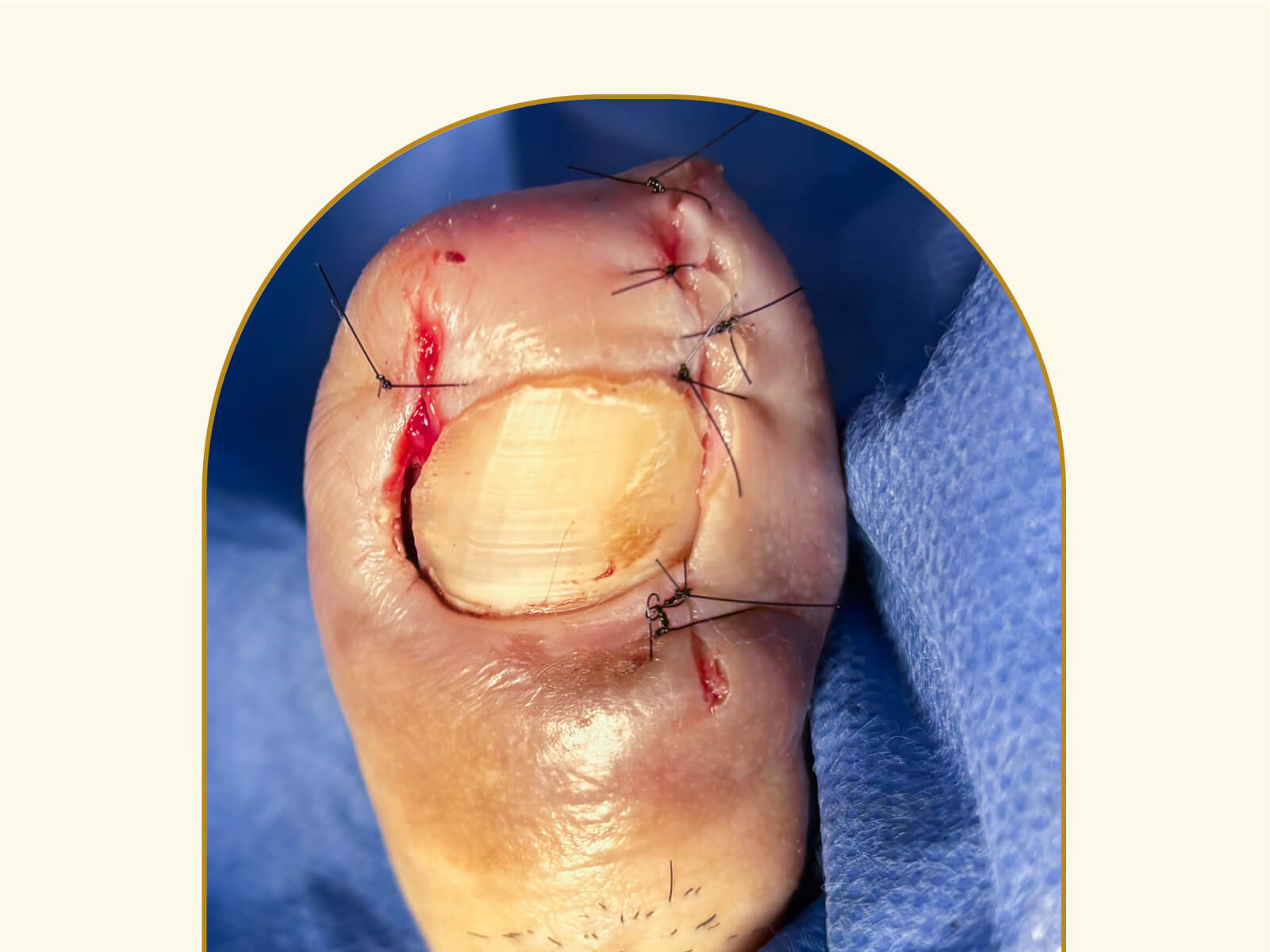 Matricectomia